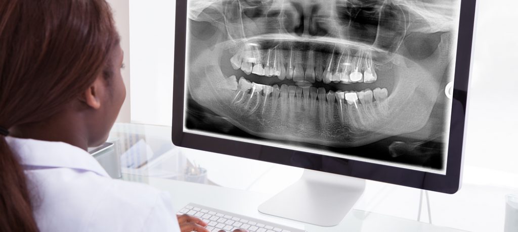 What Should I Know about Full Mouth Dental Implant Options?