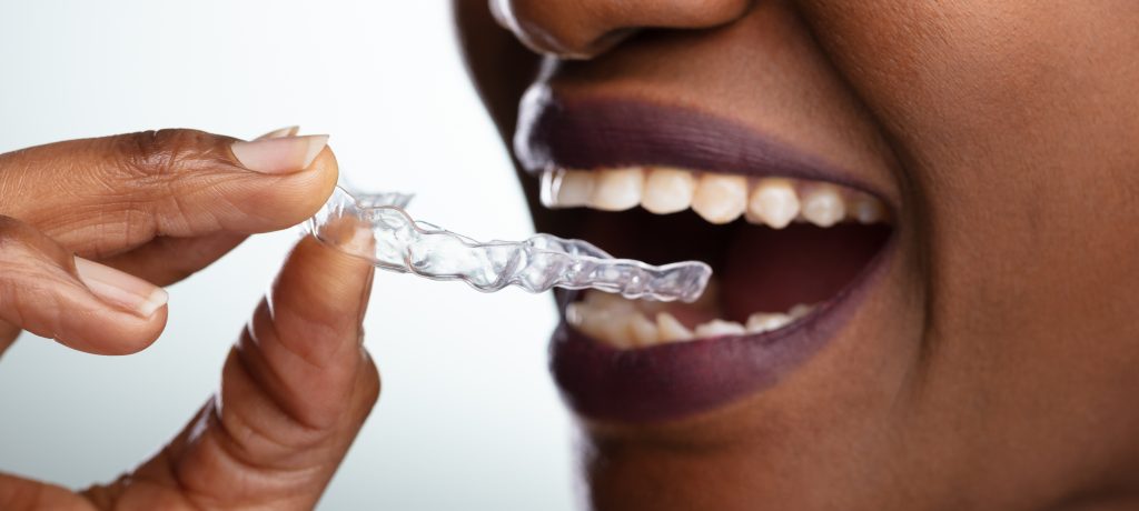 Invisible Braces  What are my orthodontic options?
