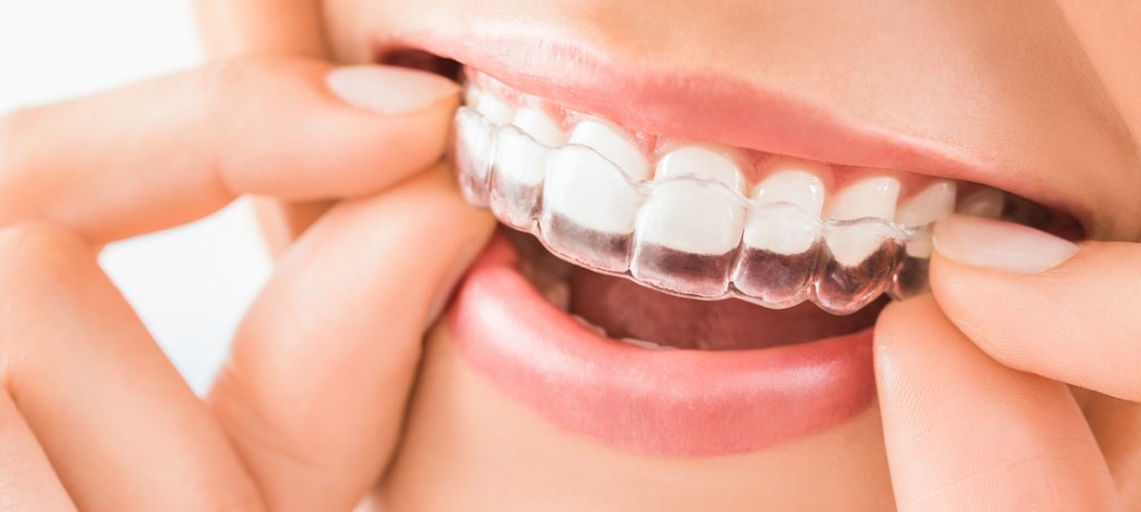 Invisalign Before And After | Penn Dental Family Practice
