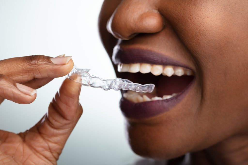 An African American woman prepares to put her invisible braces into her mouth. 