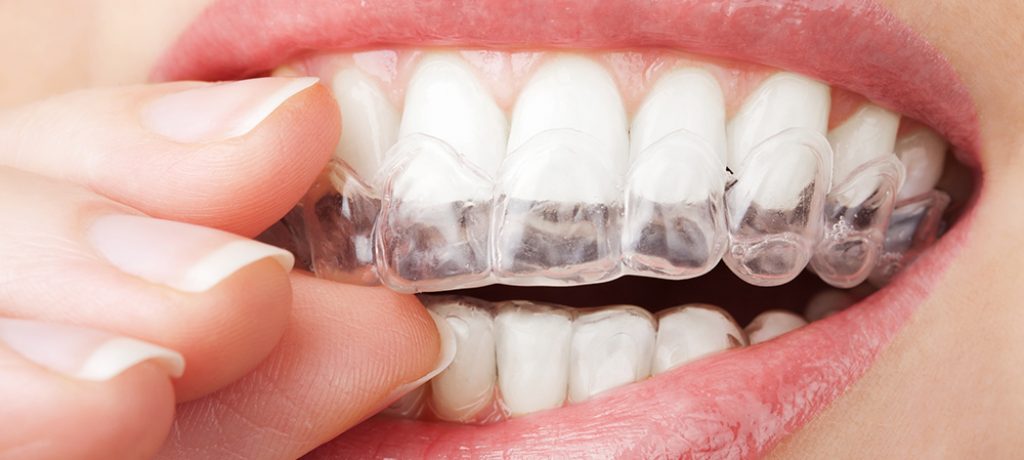 One Simple Question: Are Invisible Braces Worth It?