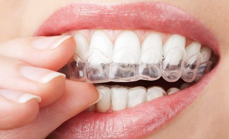 One Simple Question: Are Invisible Braces Worth It?