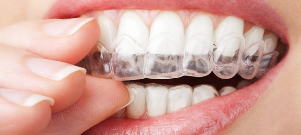 The Best Ways to Get Straight Teeth (And Why It Matters)