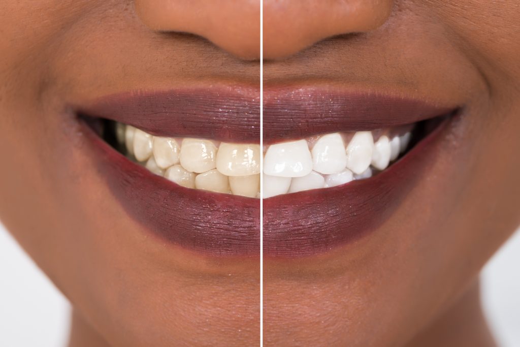 Close-up detail of a smiling Black woman showing the before and after of teeth whitening treatment