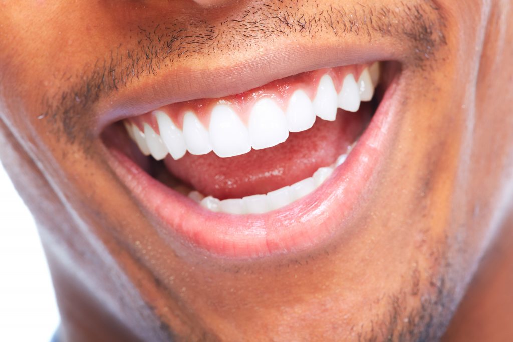 Close up of a black man’s mouth and chin smiling to reveal white teeth from teeth whitening procedure.