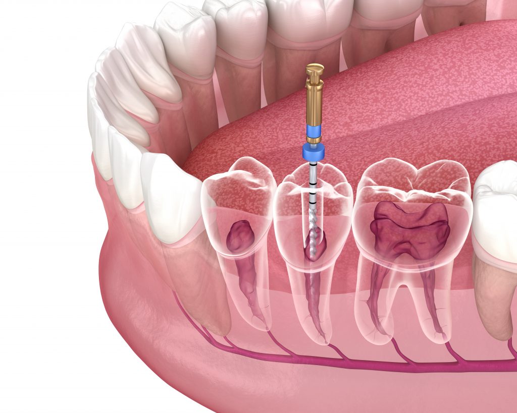  Illustration of root canal procedure, showing internal tooth anatomy