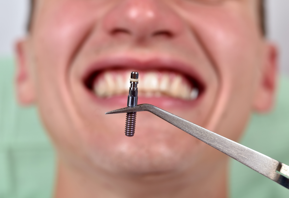 Image result for Dental Implants For Tooth Restoration