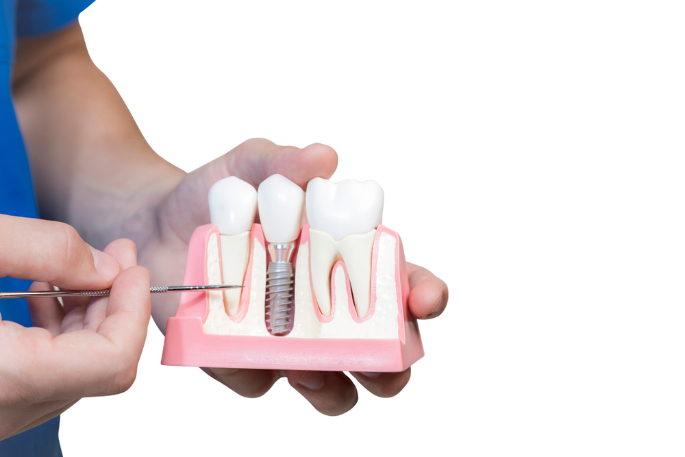 A person holding a model of a dental implant with a screw base. 