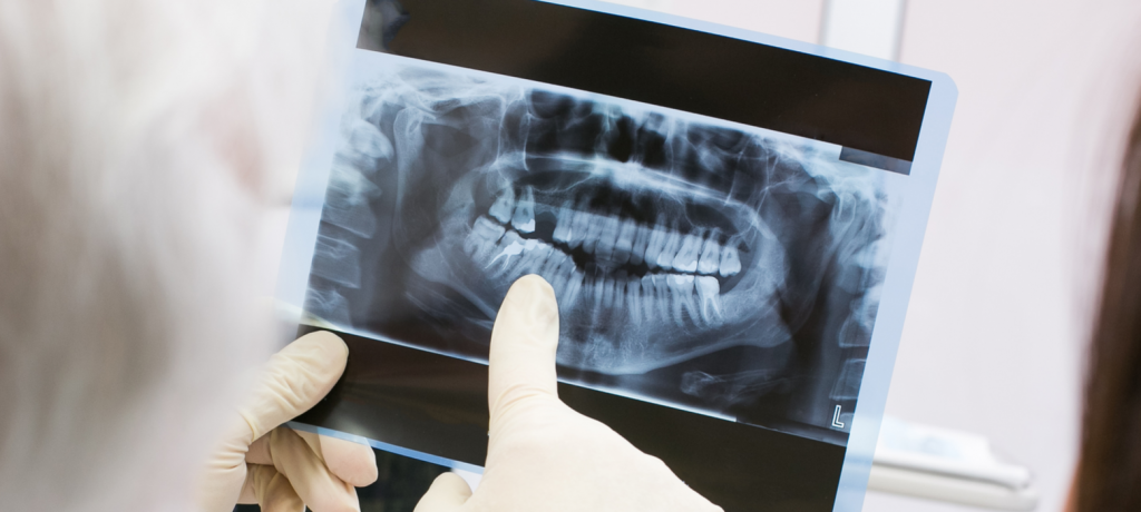 Dental Surgery: Beyond Wisdom Tooth Extraction