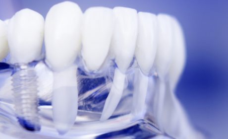 Your Search for the Best Tooth Implant Specialists Ends Here