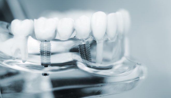Are Dental Implants Expensive?