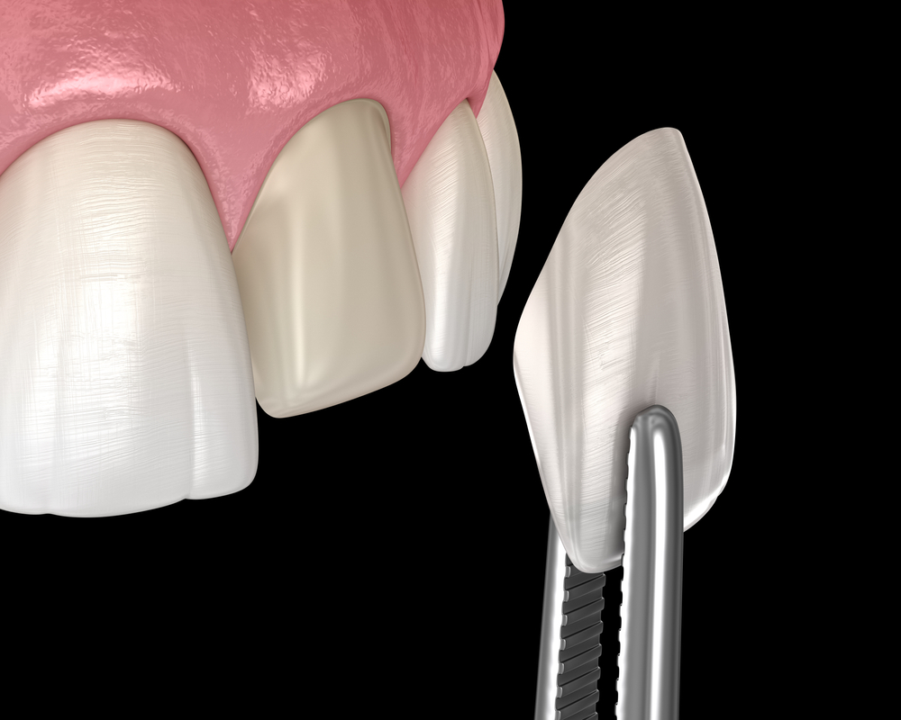 Dental Implants vs Veneers Penn Dental Family Practice