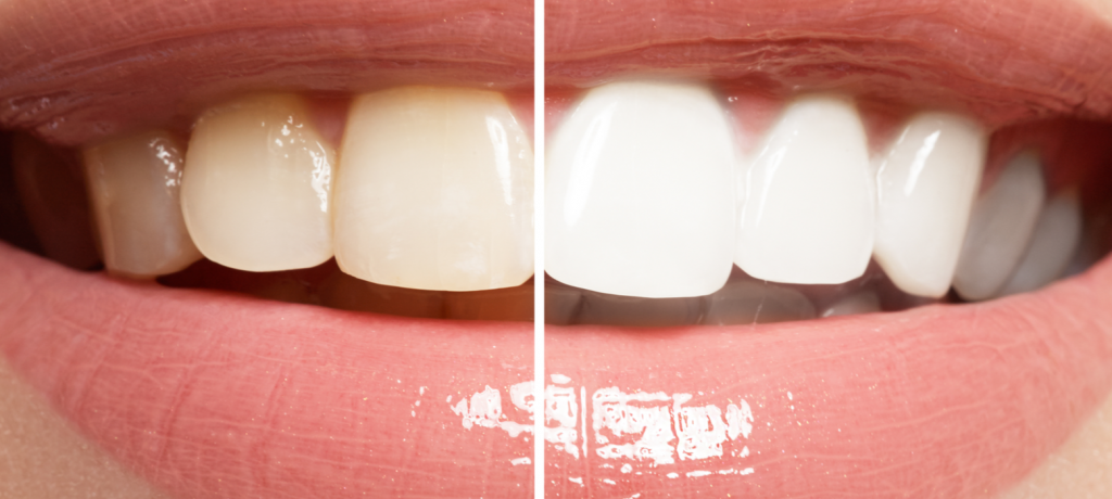 Real Options for Teeth Whitening
