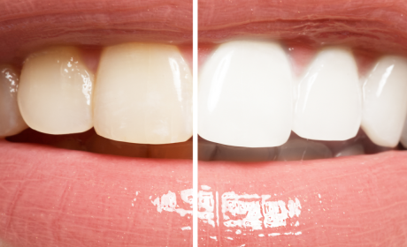 Real Options for Teeth Whitening