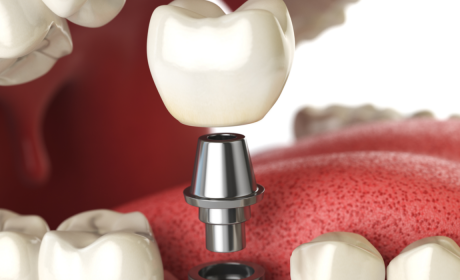 The Five Biggest Advantages to Getting Dental Implants