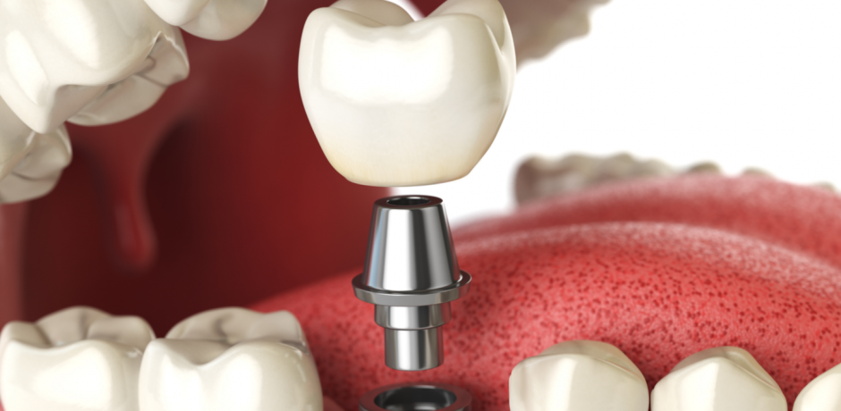 The Five Biggest Advantages to Getting Main Line Dental Implants