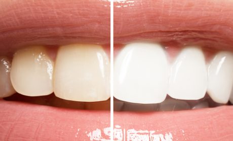 What Can a Teeth Whitening Dentist Do For You?