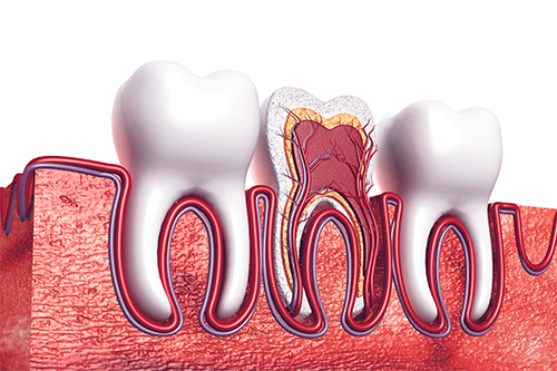  does a root canal hurt