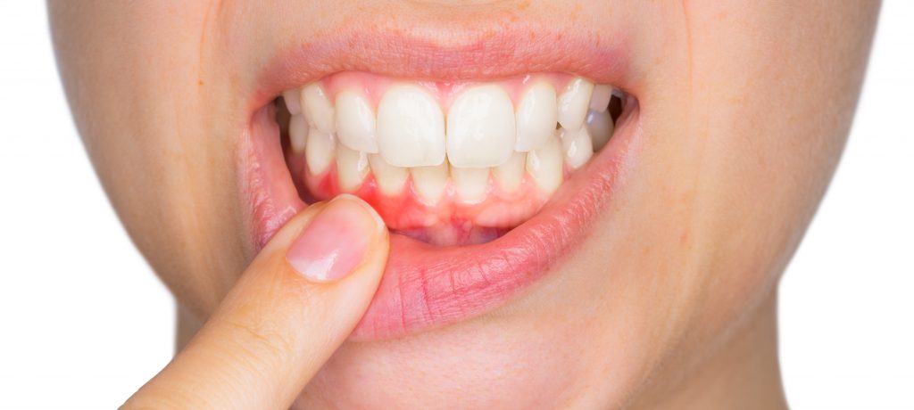 how can i fix my receding gums at home