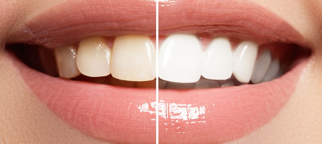 What Can a Teeth Whitening Dentist Do For You?