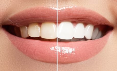 What Can a Teeth Whitening Dentist Do For You?
