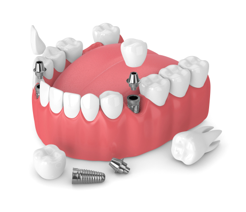 dental prosthetic services