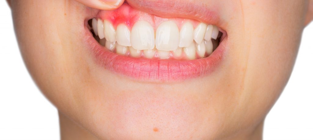 Everything You Need to Know About Receding Gums (But Were Afraid to Ask)