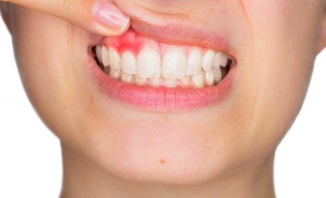 Everything You Need to Know About Receding Gums (But Were Afraid to Ask)