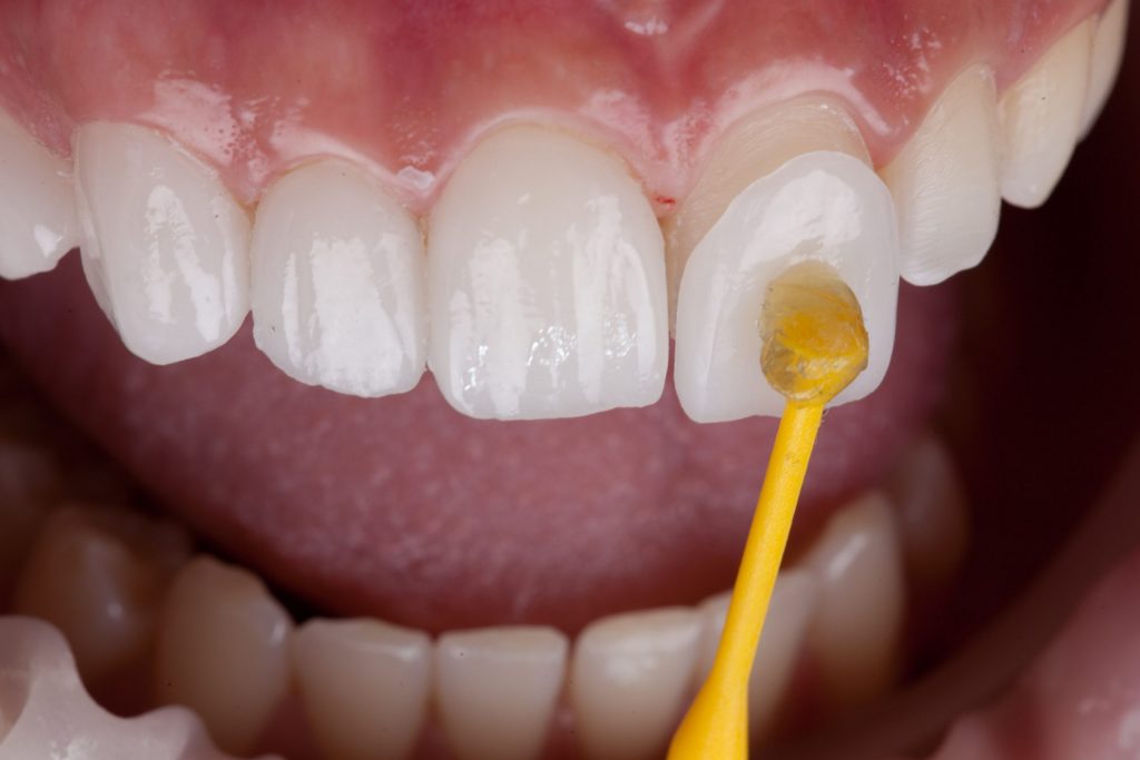 A porcelain veneer is being applied to patient’s front tooth during the veneering process by a cosmetic dentist. 