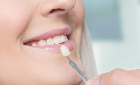 What Are Veneers and How Long Do They Last?