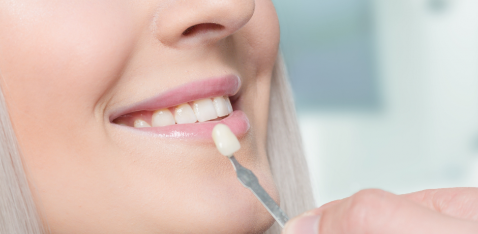 What Are Veneers and How Long Do They Last?