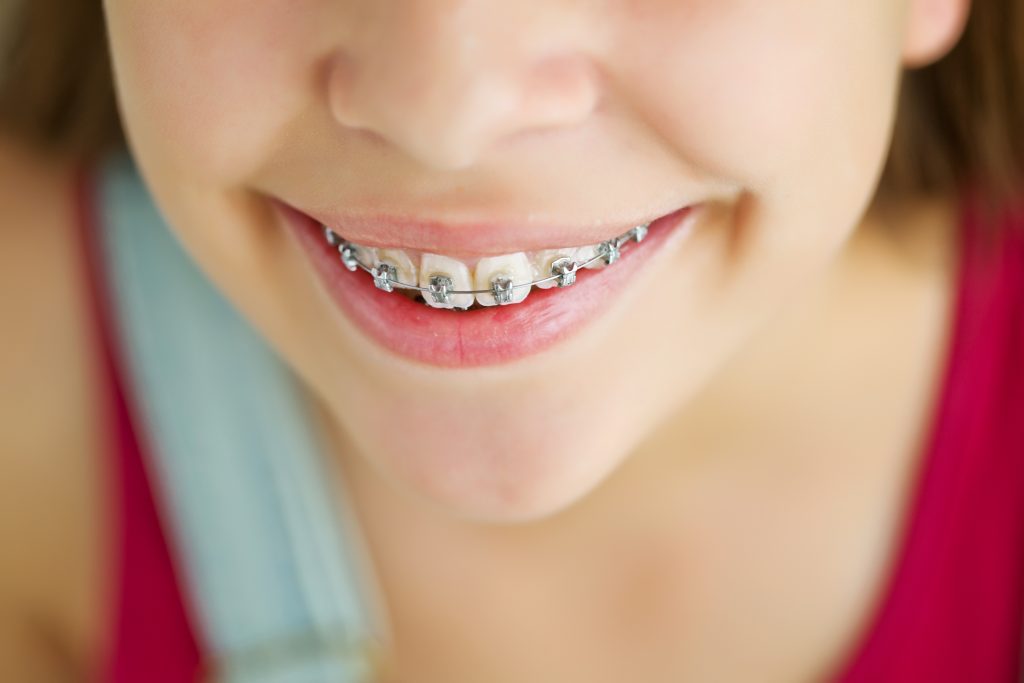  Young girl from nose down, smiling wearing traditional braces. 