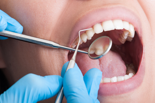 Close-up of beautiful set of teeth as patient opens mouth, while dental hygienist examines them with a mirror and dental tool.