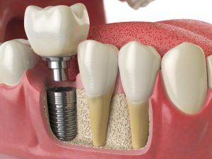 Healthy teeth plus dental implant in model of human mouth.