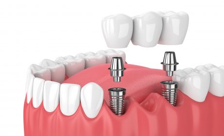 Discover our Dental Implant Center for Expert, Complex Care