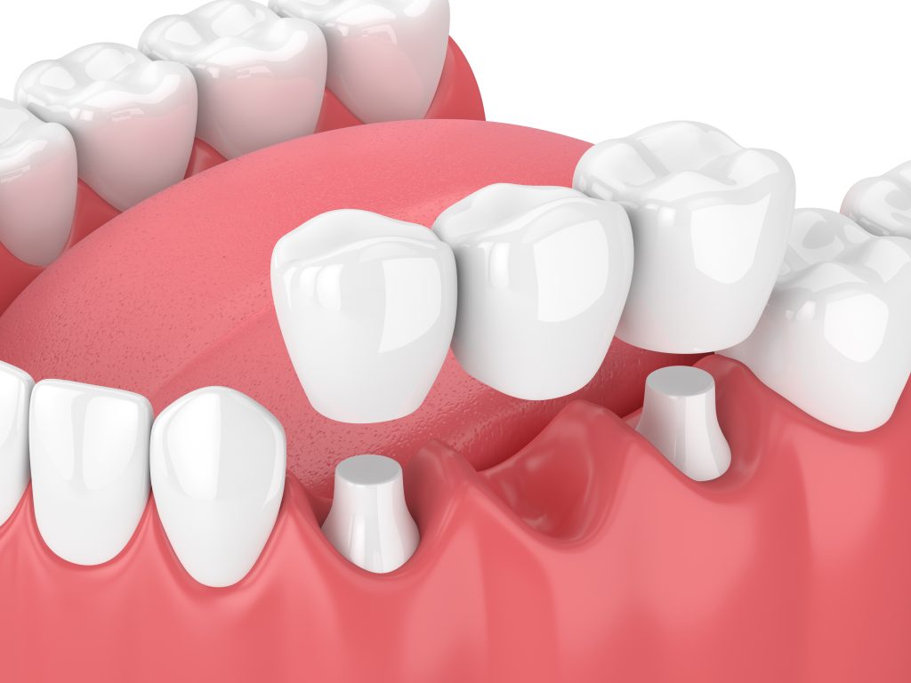 A 3D illustration of a dental bridge.