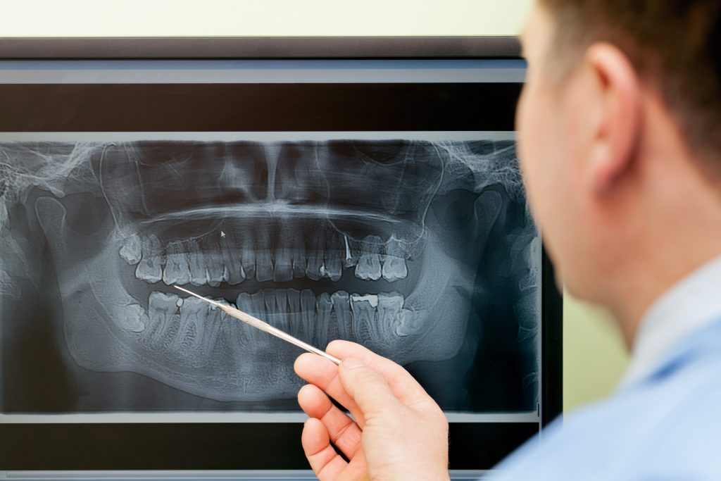 A male oral surgeon points to a radiograph of a patient in need of wisdom teeth extraction. 