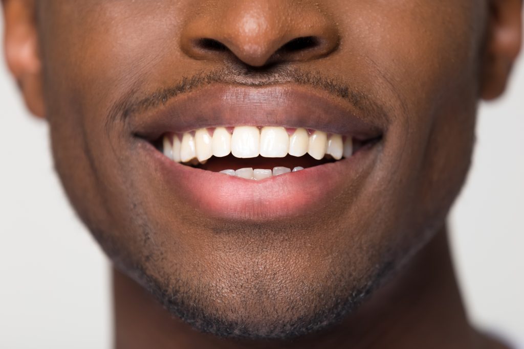 Black man smiles showing his white, perfectly aligned teeth after receiving cosmetic dental care.