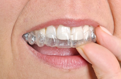  Woman’s mouth close-up as she inserts invisible braces over teeth with hand.