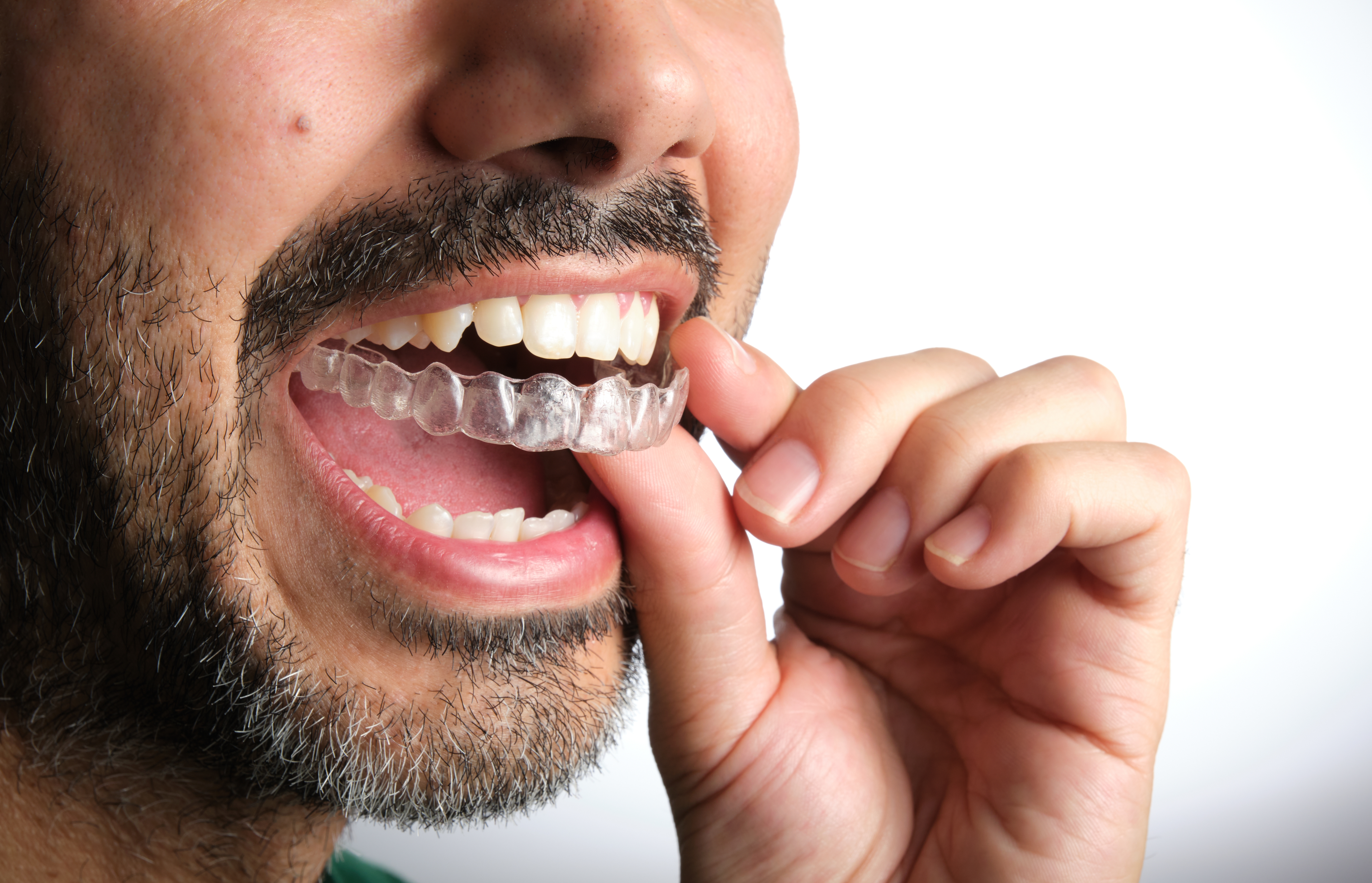 Man with beard removes a clear aligner from his mouth. 