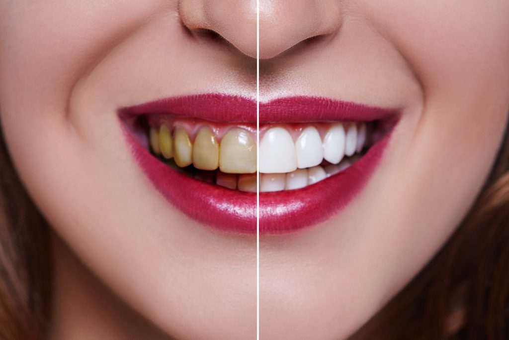  Side-by-side dental veneers before and after view shows how porcelain veneers brighten a woman’s smile.