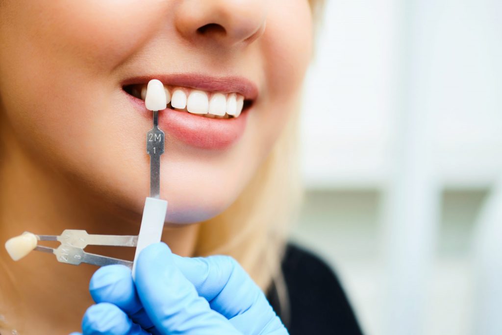 Close up of blonde white woman getting her teeth whitened by a dentist in blue glove.