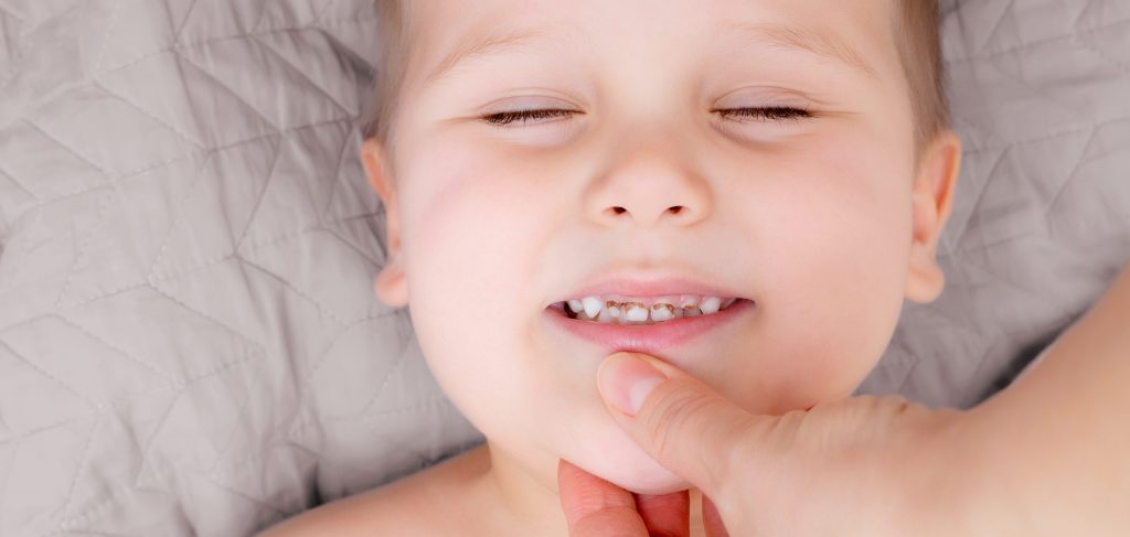 Parent holds young child’s chin as child squints and smiles, showing evidence of kid’s rotten teeth.