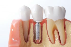 A model of teeth shows an implant between two teeth that can be done at the top Greater Philadelphia oral surgery, PDFP. 