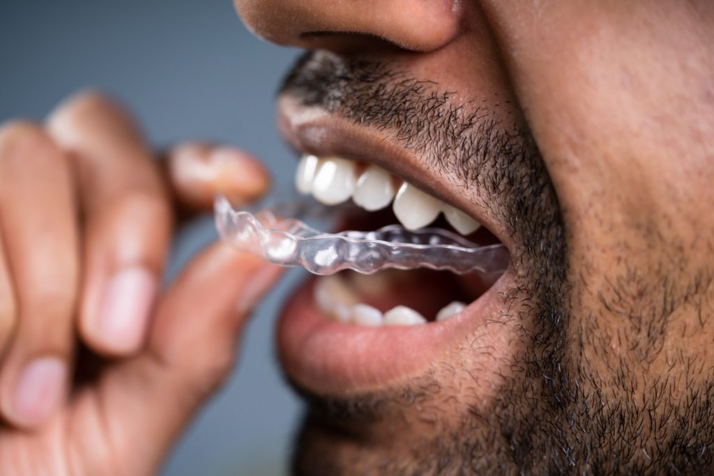 A man with a mustache and beard is putting an invisible aligner into his mouth. 