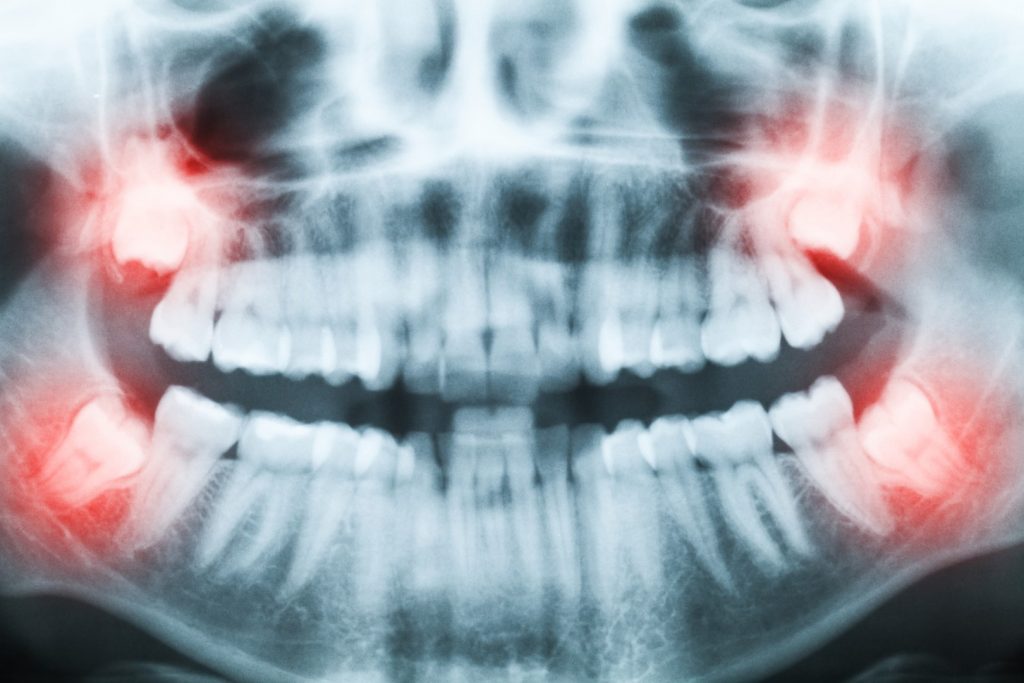 An X-ray of a mouth showing four impacted wisdom teeth in red, one in each corner.