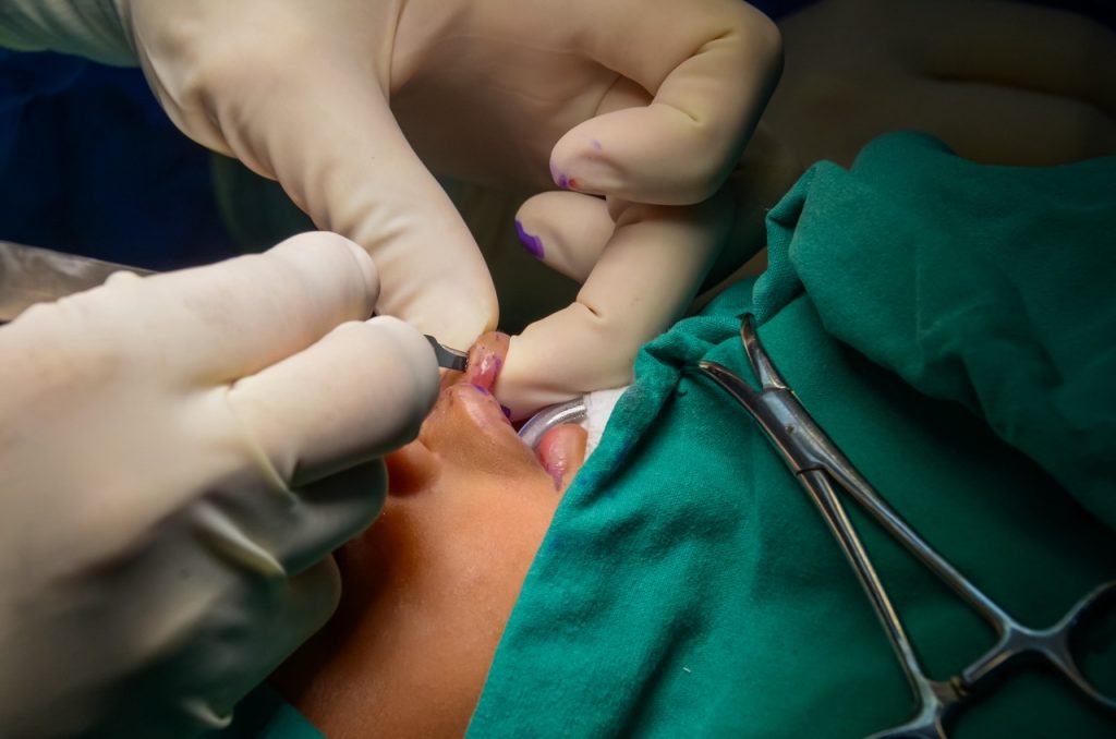 Oral surgeon repairs patient’s cleft palate.