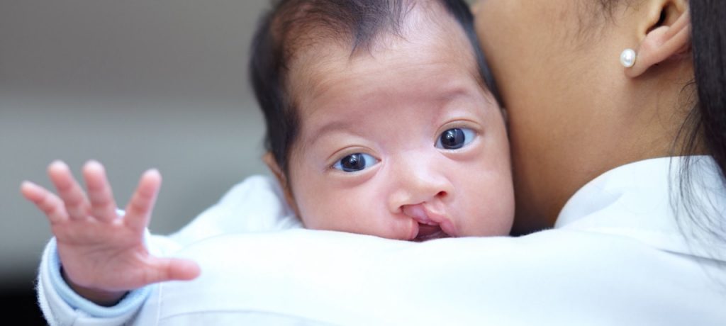 What You Need To Know About Your Child’s Cleft Palate