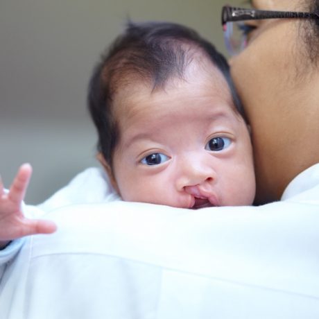 What You Need To Know About Your Child’s Cleft Palate