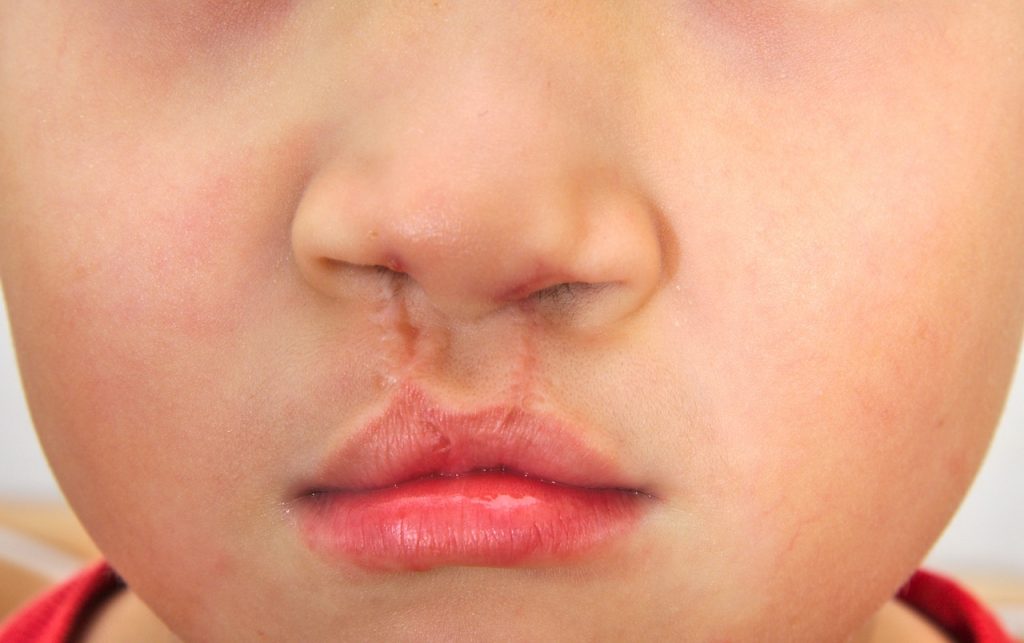 Scars on elementary school-age boy’s upper lip is evidence of oral surgery to repair his cleft palate. 